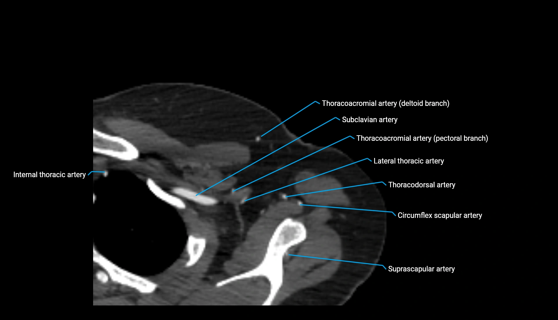 CTA upper limb axial cross sectional anatomy labelled image 338 (1).webp
